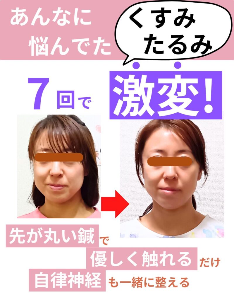 あんなに悩んでいたくすみ・たるみが7回で激変！先の丸い鍼で優しく触れるだけ自律神経も一緒に整える